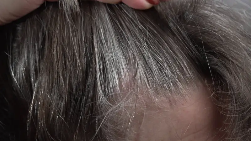 الأسباب الكامنة وراء ظهور الشيب في سن مبكرة