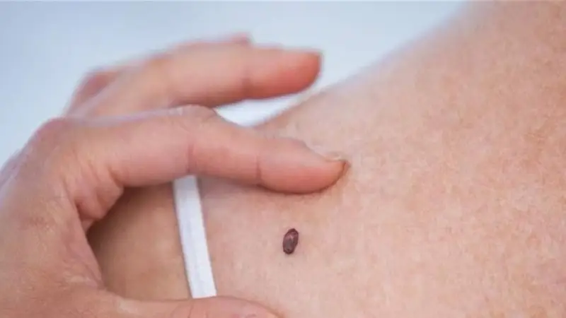 When Does a Mole Become a Health Concern? Warning Signs to Watch For