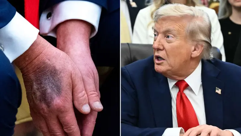ترامب: هذا ما يفسر ظهور الكدمات على يدي