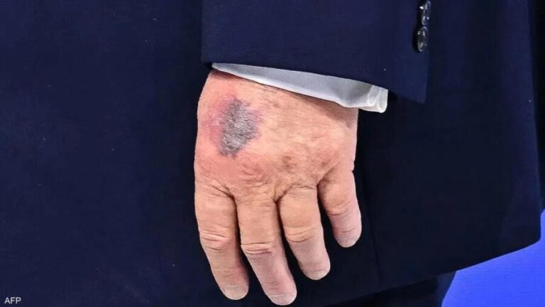 After the controversy over Trump’s hand bruise… the White House explains its cause