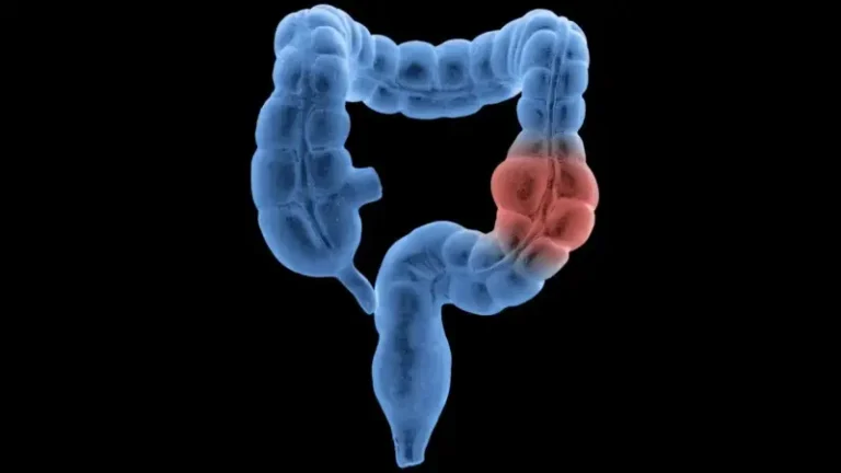 Learn about the symptoms of colorectal cancer