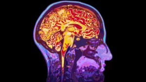 Accumulation of plastic nanoparticles in human brains